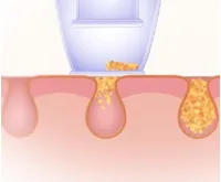 Wellneo Vakuový čistič pórů (1)